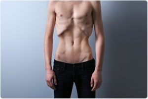 Torso muy delgado de una persona de pie, imagen sobre los síntomas de la anorexia nerviosa